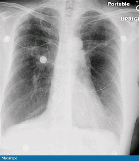 Just Say No to Treating This Pulmonary Infection