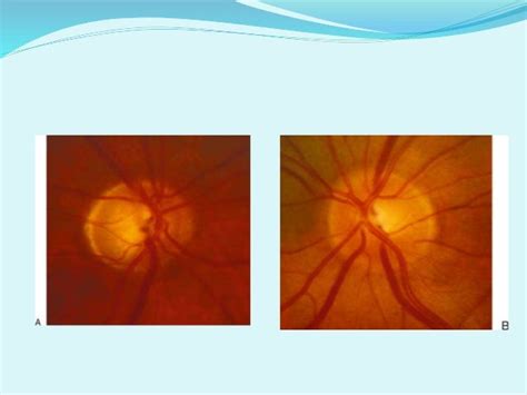 Oct in glaucoma