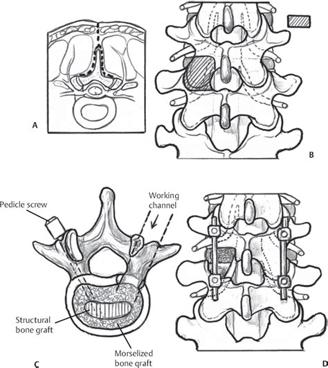 Transforaminal Posterior Lumbar Interbody Fusion | Neupsy Key