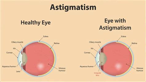 Double Vision (Diplopia): Symptoms, Associated Conditions, and ...