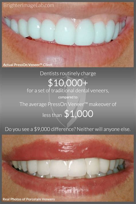 Press On Veneers™ vs Lumineers - The first set of removable veneers we ...