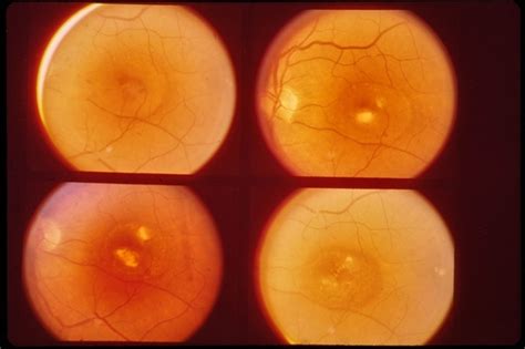 Central Serous Retinopathy - Retina Image Bank