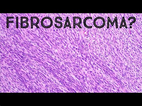 Fibrosarcoma Histology