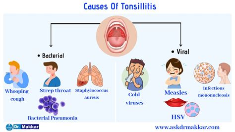 Tonsillitis Pathophysiology