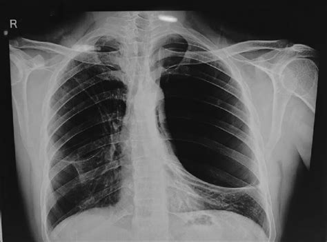 Chest X-ray showing presence of bilateral giant lung bulla | Download ...