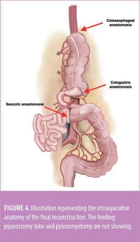 Colonic Interposition Graft as a Conduit following Esophagectomy for ...