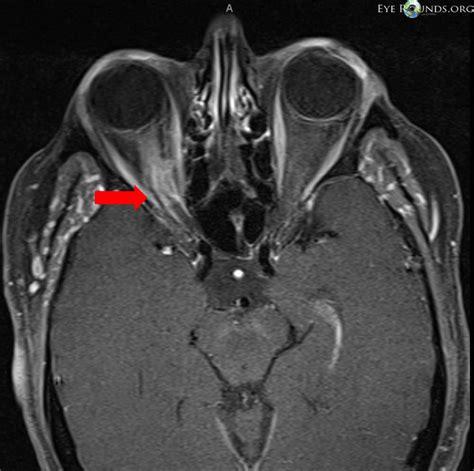 Atlas Entry - Optic nerve sheath meningioma