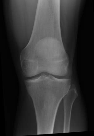 Normal knee x-rays | Radiology Case | Radiopaedia.org