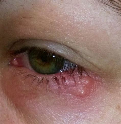 Can You Get Herpes Inside Your Eyelid at Shawanda Peters blog