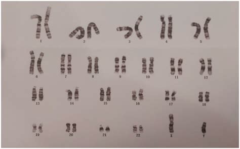 Karyotype analysis of the peripheral blood. | Download Scientific Diagram