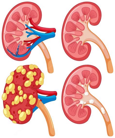 Premium Vector | Diagram of kidney with disease