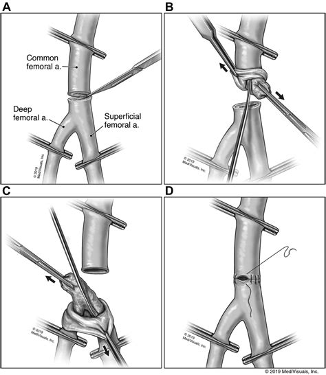 Experience with Eversion Endarterectomy of the Common Femoral Artery with Comparison to Standard ...