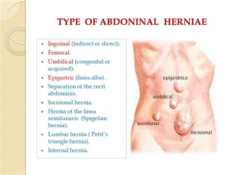 Linea Alba Hernia