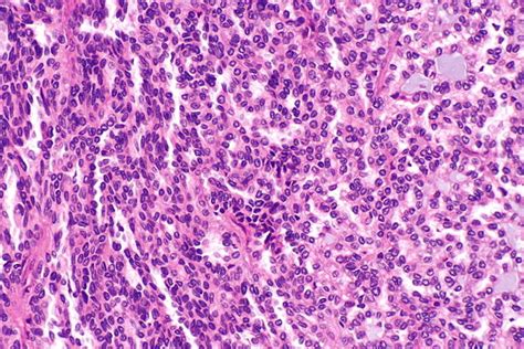 Renal mucinous tubular and spindle cell carcinoma - Libre Pathology