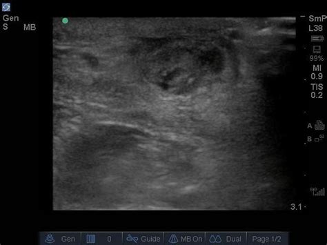 Achilles Tendon Rupture, by Dr. Joshua Guttman - The EM Pulse