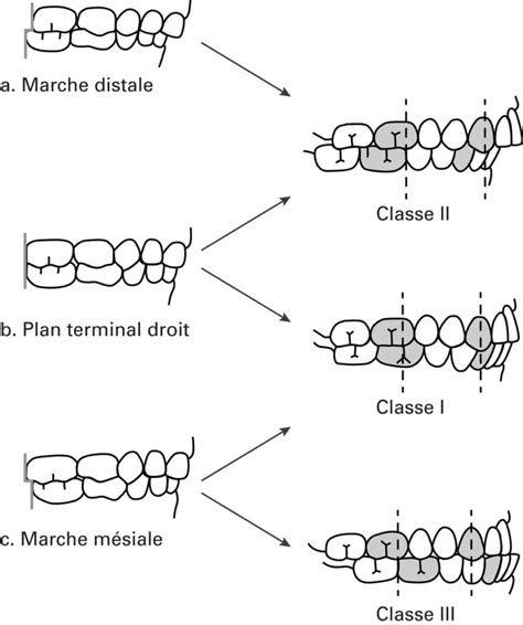 Occlusion dentaire et Malocclusion : qui consulter ? → Orthodontiste Lyon 3 Montchat