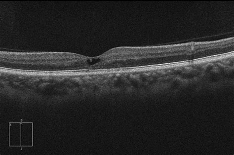 Macular Telangectasia Type 2 OCT OD - Retina Image Bank