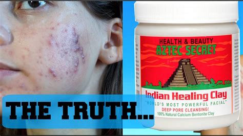 GETTING RID OF ACNE IN ONE WEEK EXPERIMENT|| Using Indian Healing Clay Mask Bentonite Clay - YouTube