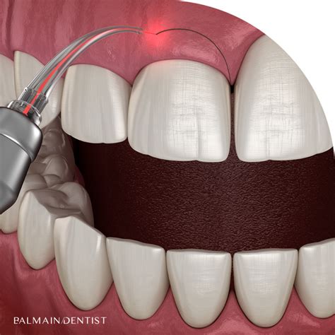 Gum Contouring / Gummy Smile | Balmain Dentist