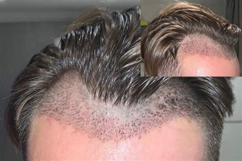 What You Need To Know About Shedding After A Hair Transplant