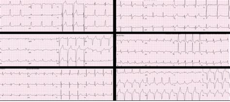 Examples of intraventricular conduction delays on ECG. Counterclockwise ...