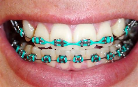 163 best Braces Colors images on Pinterest | Braces colors, Dental and Teeth