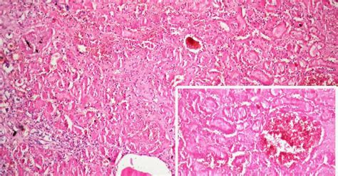 1-Necrosis renis /№ 34. Infarctus anaemicus renis/. | Pathology