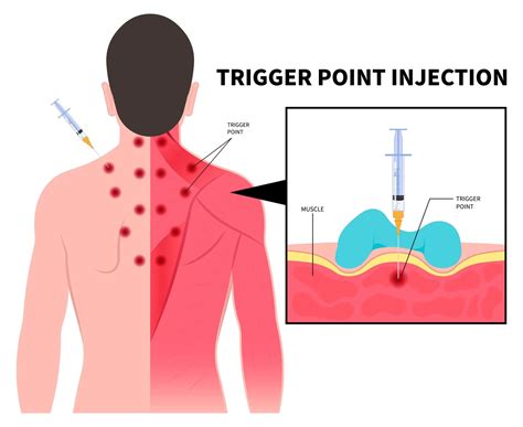 Trigger Point Injection - Purpose, Procedure, Technique