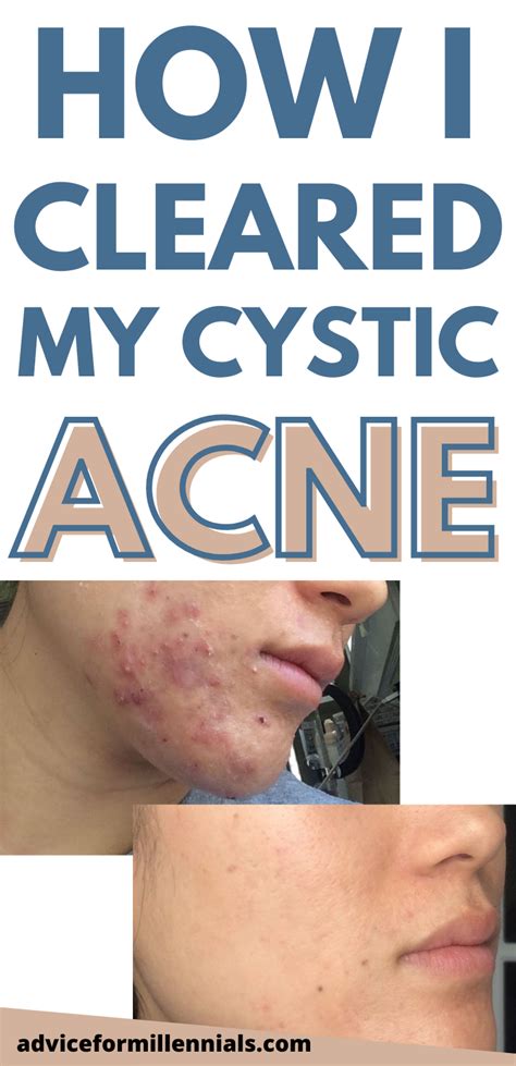 How I Cleared My Cystic Acne WITHOUT Accutane | Hormonal acne treatment ...