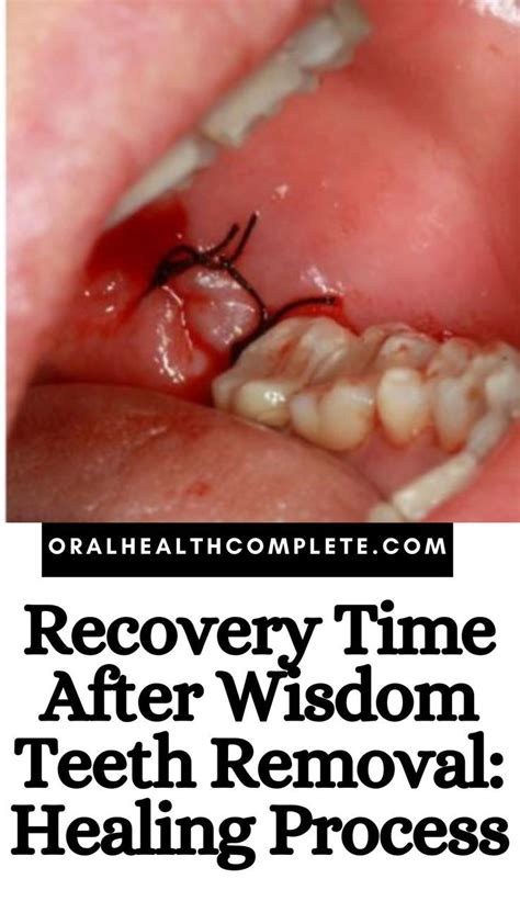 Recovery Time After Wisdom Teeth Removal Reduce Swelling In Face ...