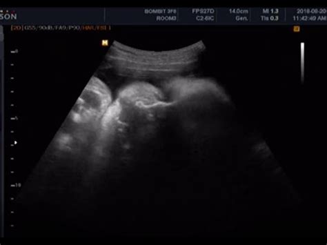 fetal ultrasound of 36 weeks-37weeks baby boy moving - YouTube