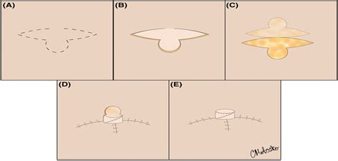 Reconstruction of Defects on the Nipple–Areola Complex : Dermatologic Surgery