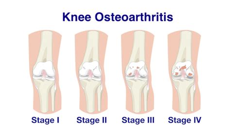 Osteoarthritis Stages Knee