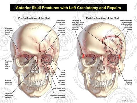 Basilar fracture - whichlomi