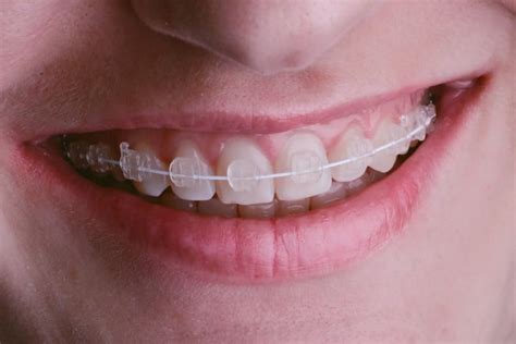 The Truth about Ceramic Braces - Orthodontist Parkersburg Ripley WV Invisalign Braces | Smith ...