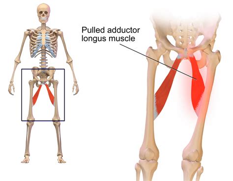 Groin strain: Symptoms, treatment, and recovery