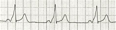 PR Interval • LITFL • ECG Library Basics