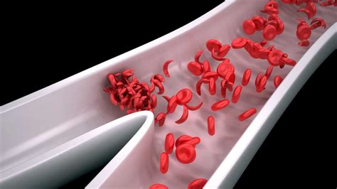 Sickle Cell Anemia | China| PDF | PPT| Case Reports | Symptoms | Treatment