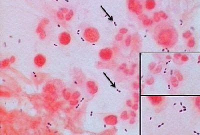 csf gram stain s. pneumo. Gram POSITIVE diplococci | Medical laboratory science, Microbiology ...