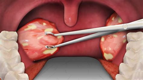 tonsil removal surgery - Jeffrey Decarvalho