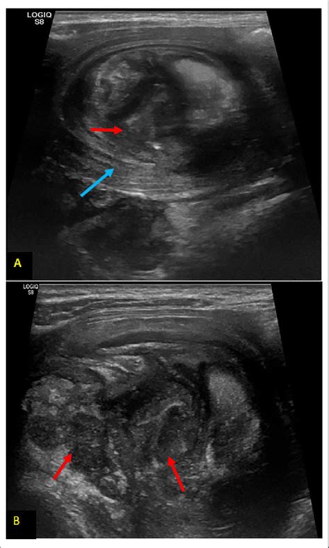 Ultrasound images (A, B) showing an epigastric mass of 4x6cm with... | Download Scientific Diagram