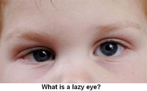 Lazy Eye Causes, Diagnosis And Treatment | Health And Beauty