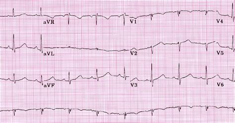 Study Medical Photos: QT Interval Prolongation On ECG