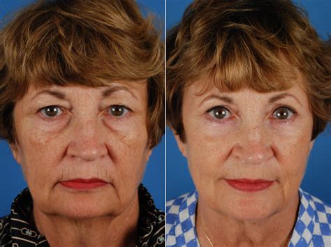 Eyelid Surgery in Naples, FL | Aesthetic Surgery Center