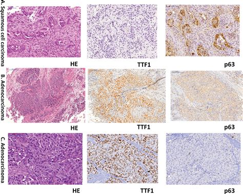 SciELO - Brasil - Lung cancer biopsy: Can diagnosis be changed after immunohistochemistry when ...