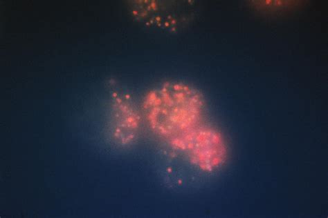 Photodynamic Therapy to Treat Cancer - NCI