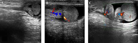 Epididymal or Testicular Ultrasonic Findings: Which One is More Reliable for Differentiation of ...