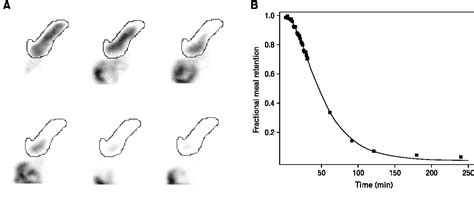 Figure 1 from Normal Solid Gastric Emptying Values Measured by ...