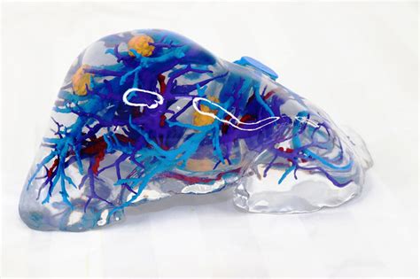 3D printed liver models identify patient-specific anatomies