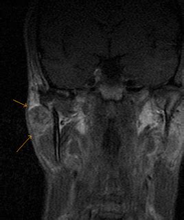 Pleomorphic Adenoma-MRI - Sumer's Radiology Blog